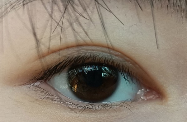 倒睫怎么辦？