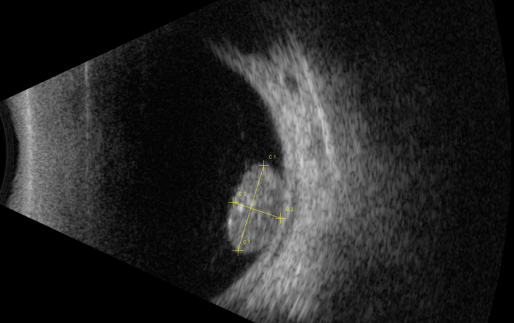 視網(wǎng)膜母細(xì)胞瘤分類