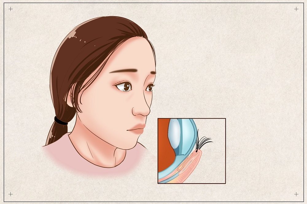 倒睫會(huì)自己好嗎？