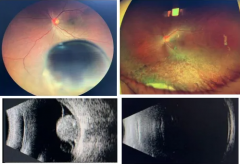 以為只是眼花，竟查出眼內(nèi)惡性腫瘤！50歲男子及時就醫(yī)后，獲“保眼”治療機(jī)會！