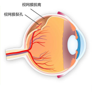 揉眼睛時(shí)出現(xiàn)閃光感是怎么回事？注意！可能是視網(wǎng)膜脫離！